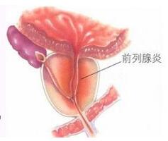 细数前列腺炎较常见的危害