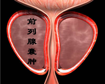 男性前列腺囊肿会出现什么症状?