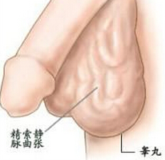 精索静脉曲张的治疗方法有哪些?